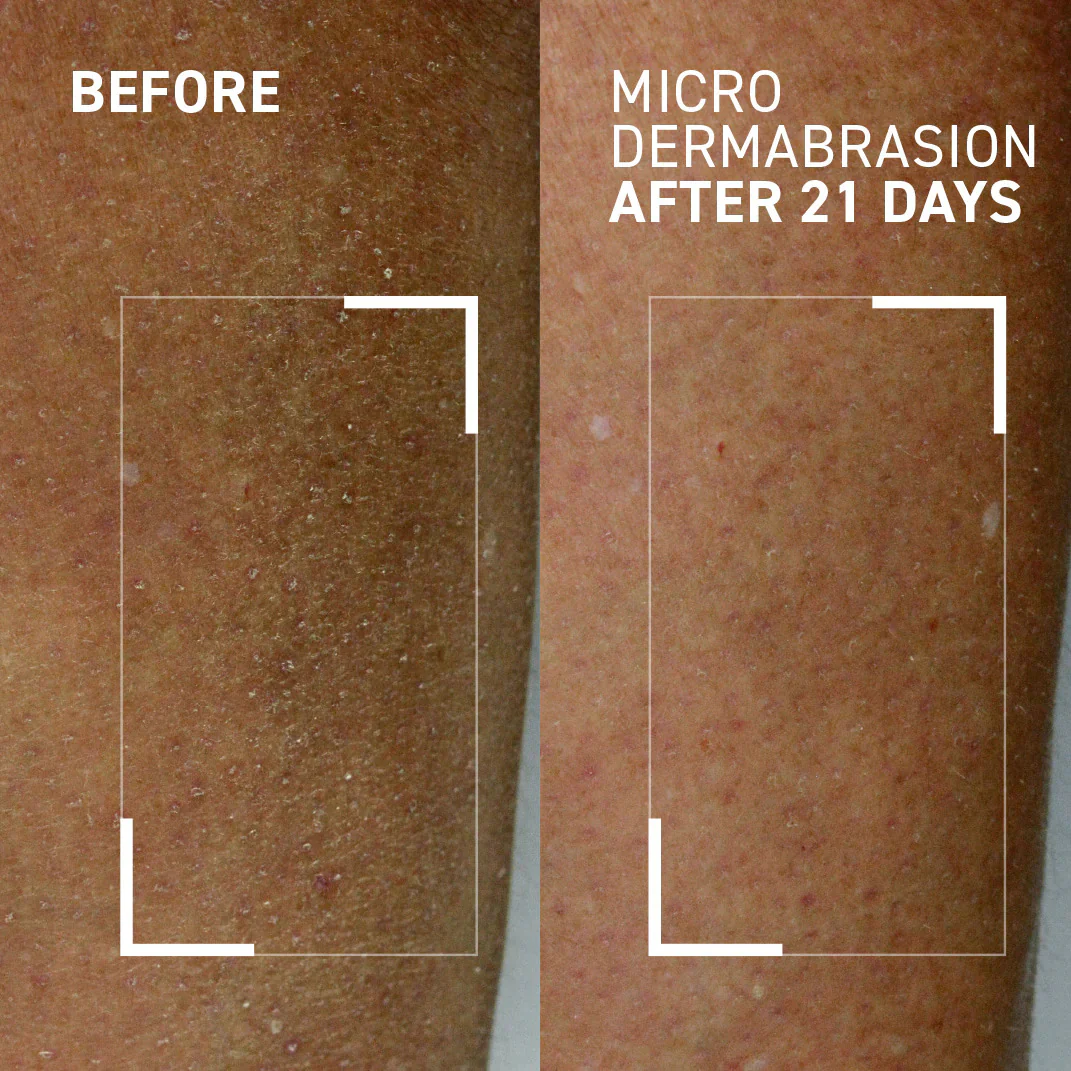 Microdermabrasion Body Polishing Exfoliator - Image 2